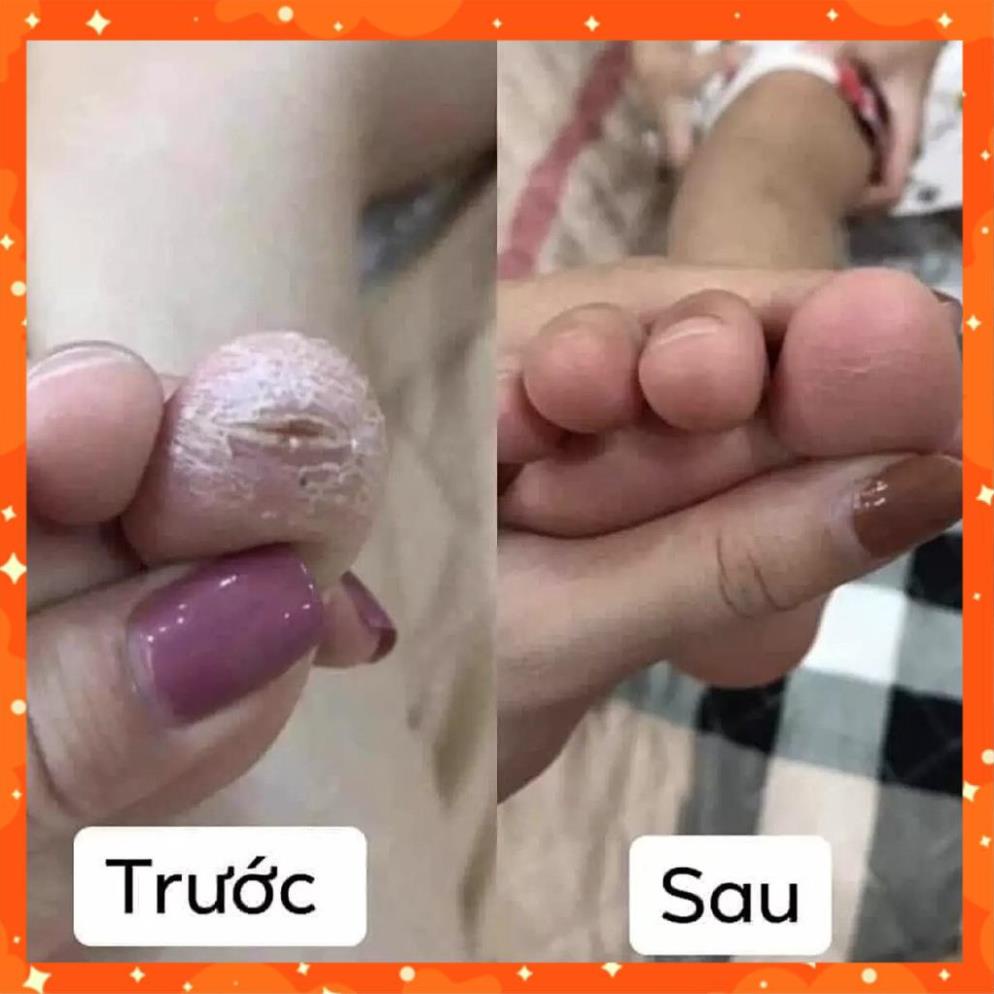 Kem bôi hắc lào, nấm ngứa hộp 15gr