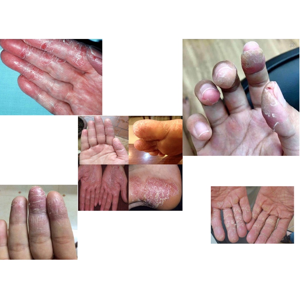 Thảo dược HẾT SẠCH bong da đầu ngón tay ngón chân, lòng bàn tay, bàn chân