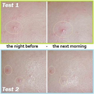 Miếng dán mụn Missha Anti Trouble Patch