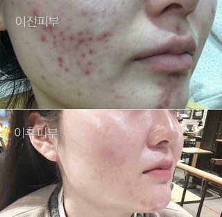 Red Peel Tingle Serum