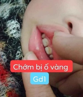 Thảo dược về răng miệng Lợi An