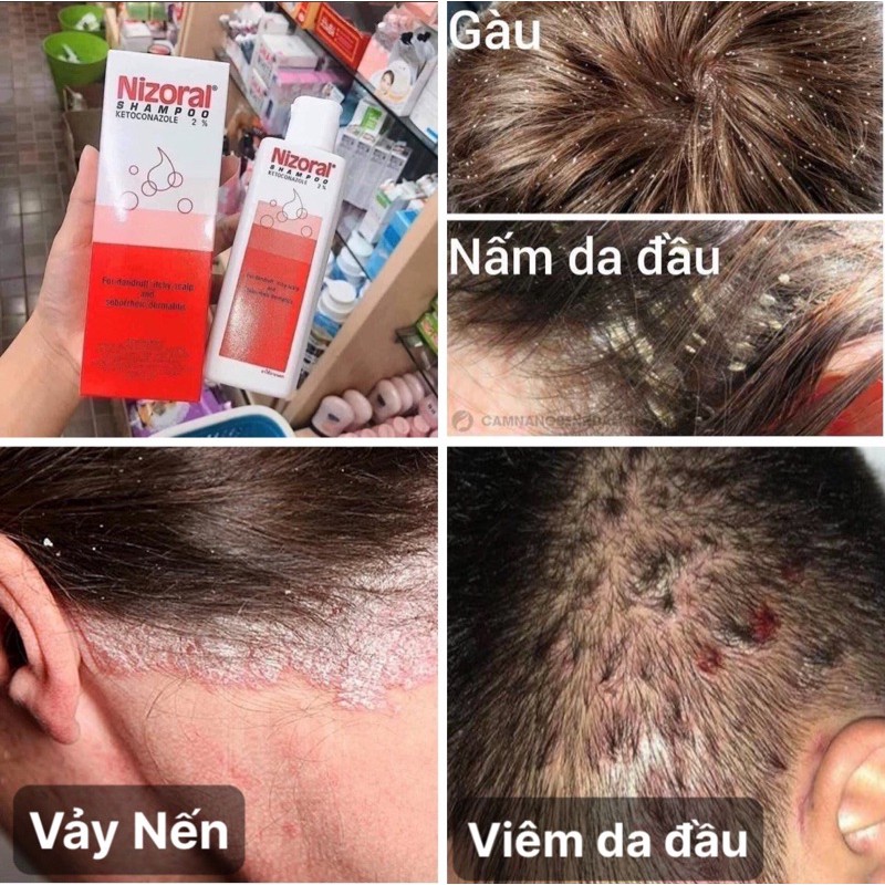 [CHỈ BÁN HÀNG THÁI] DẦU GỘI NẤM DA ĐẦU,GÀU THÁI LAN[SẴN][FREESHIP][CHUẨN HÀNG][BẢO HÀNH 7 NGÀY] | BigBuy360 - bigbuy360.vn