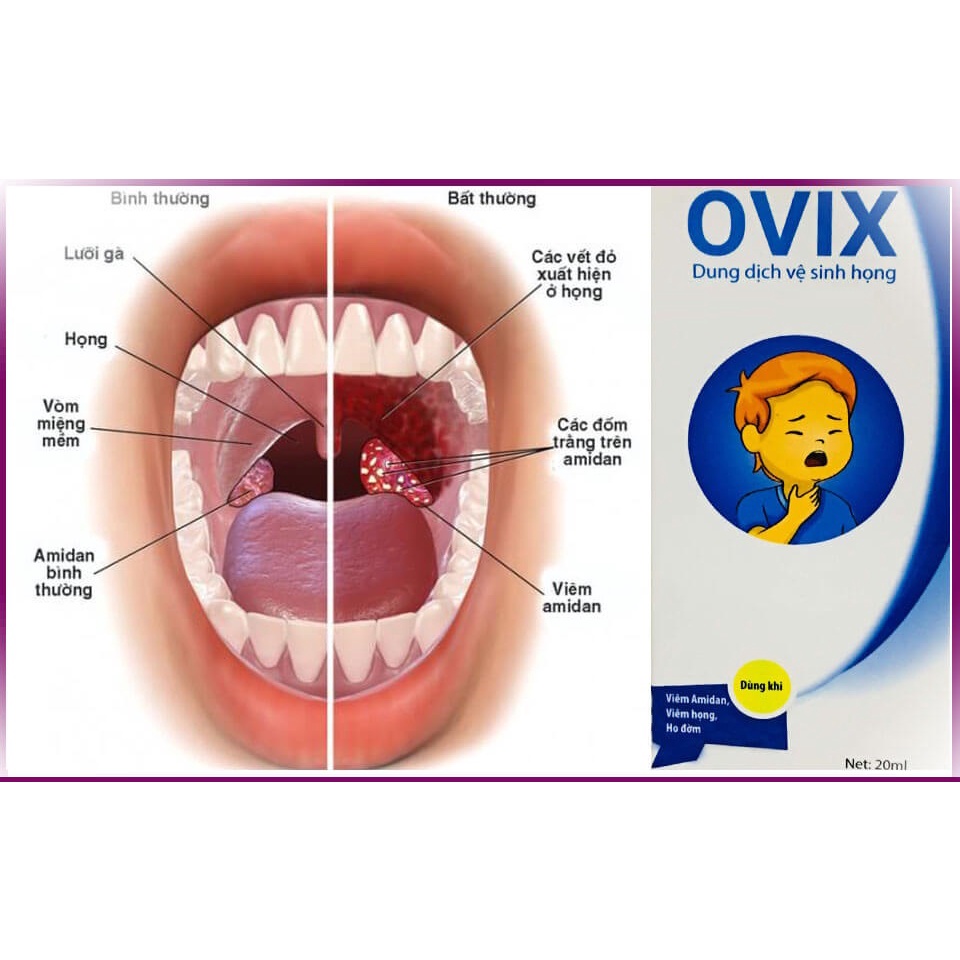 Dung dịch vệ sinh họng Ovix hết đau họng họng hạt, amydal cho trẻ em người lớn lọ 20ml