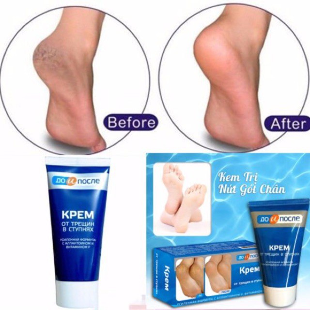 Kem dưỡng da tay chân [Hết nứt nẻ 100%-Hàng Auth] Kem chống nứt gót chân nga kpem foot cream 50ml