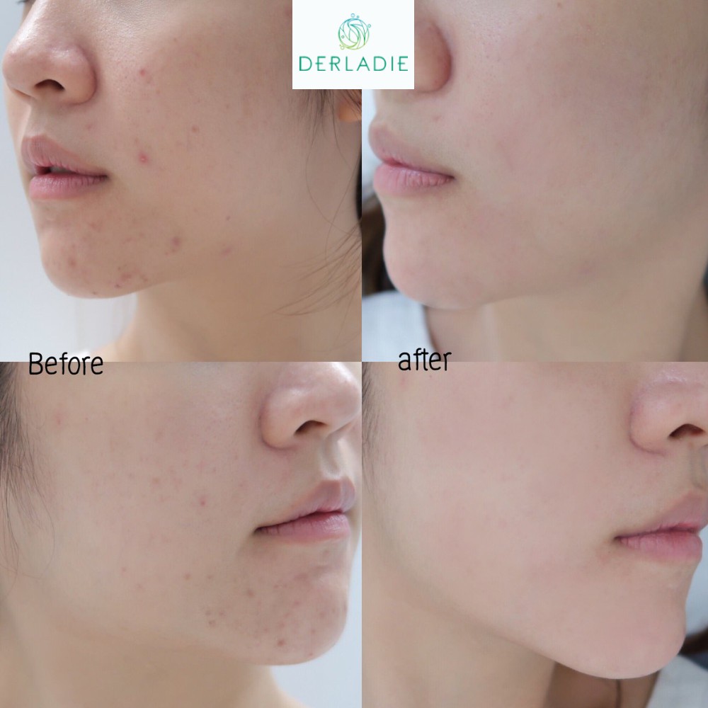 Bộ đôi Toner và Tinh Chất Tràm Trà giảm mụn sau 14 ngày Derladie Herbal For Blemish