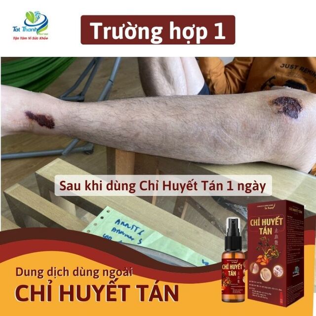 Dung Dịch Xịt Vết Thương Chỉ Huyết Tán