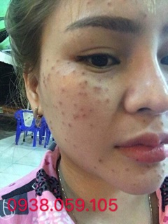 Chấm tàn nhang 7 ngày bong
