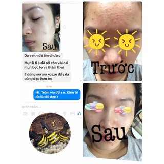 SERUM MỤN ẨN KOSXU