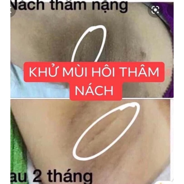 KEM THÂM NÁCH QNIC CARE- Kem thâm nách Thái Lan