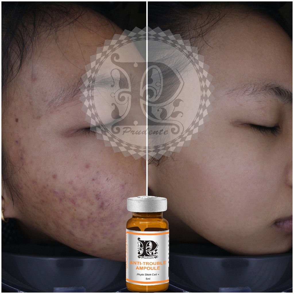 Serum Mụn Anti Trouble Ampoule [ MIBITI ] 5ml/Chai | BigBuy360 - bigbuy360.vn