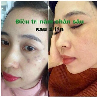 chấm nám tàn nhang