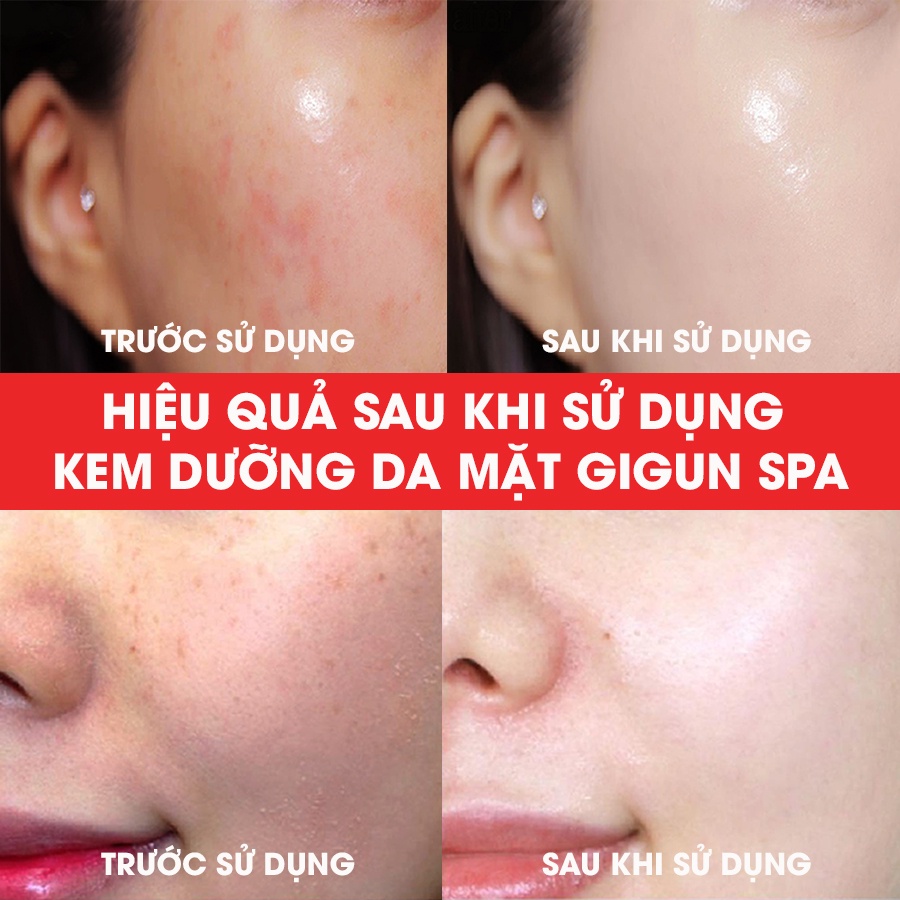 KEM DƯỠNG DA MẶT GIGUN SPA