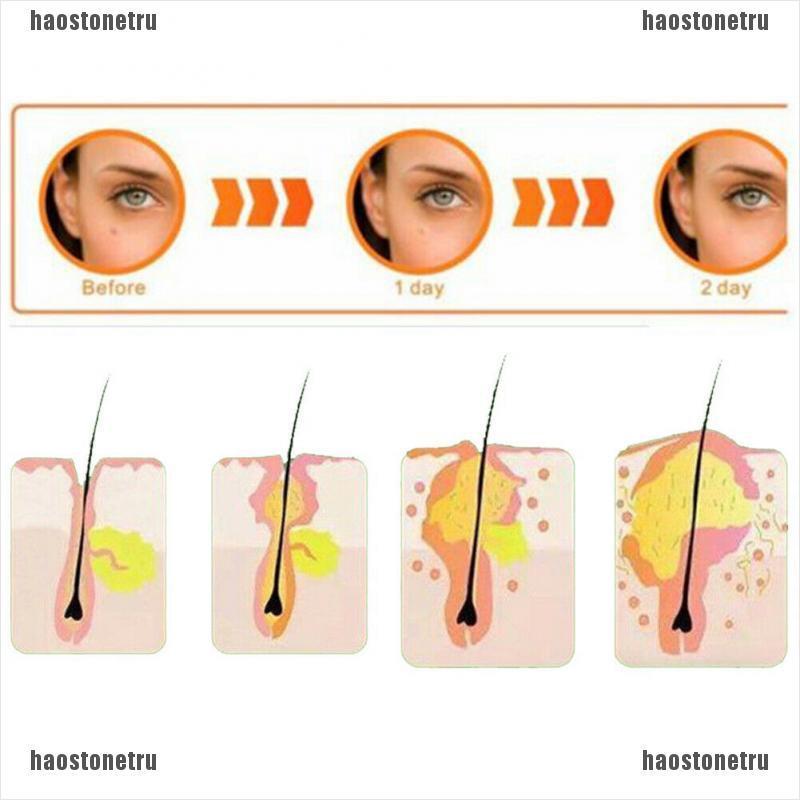 Bộ 36 Miếng Dán Mụn Hydrocolloid Và Mụn Trứng Cá