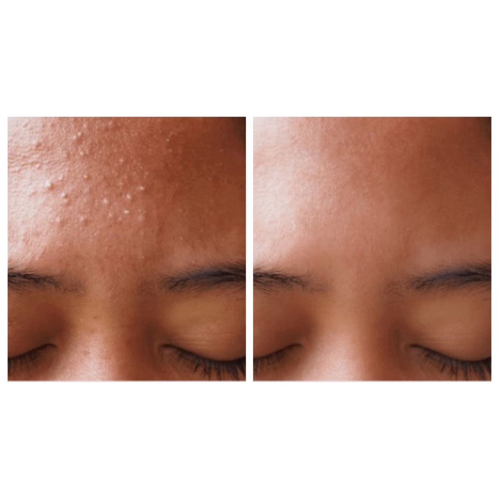 Kem ngừa mụn đẩy nhân mụn, mờ thâm +Dr.Lee Cream.