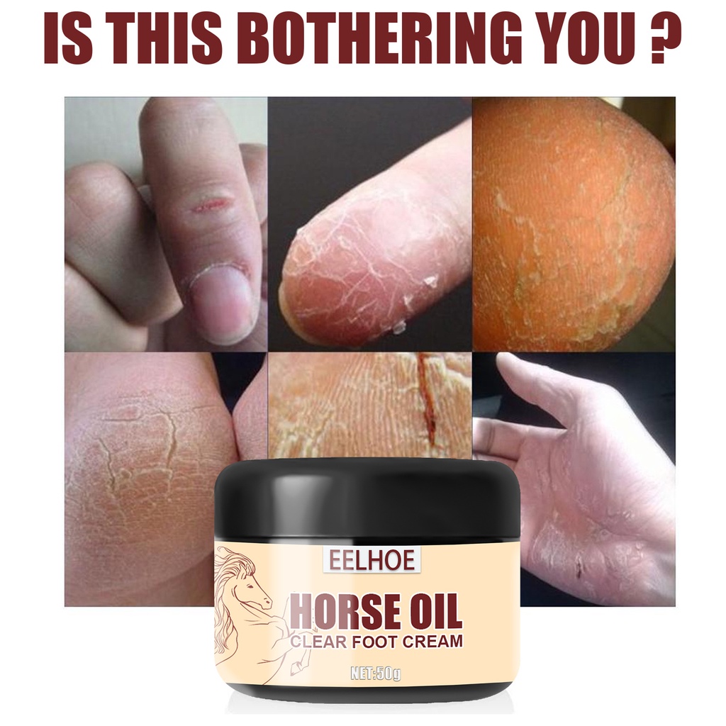 Kem Dưỡng Ẩm Chăm Sóc Da Chân Bị Nứt Nẻ Và Vết Chai Da Chân