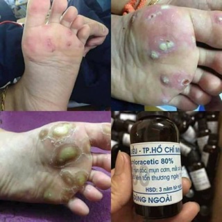 Thuốc chữa mụn cóc