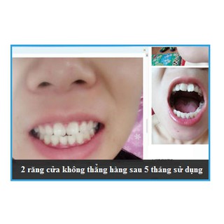 Bộ Dụng Cụ Niềng Răng Tại Nhà ( 3 giai đoạn )