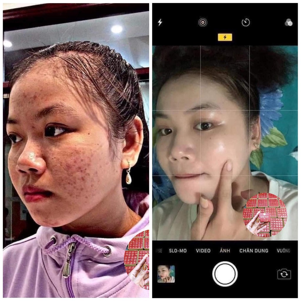 Bộ Sản Phẩm Cao Mụn Sâm Đỏ 36 Vị, Sữa Rửa Mặt Mật Nhân Sâm - Meea Orgnic | BigBuy360 - bigbuy360.vn