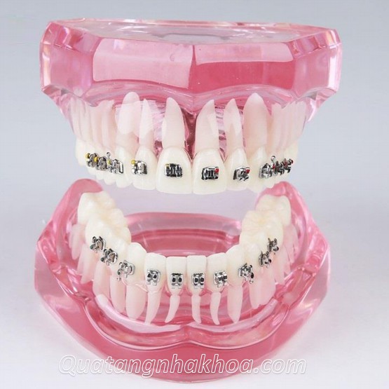 Mẫu hàm tư vấn chỉnh nha mắc cài kim loại – mô hình nắn chỉnh răng nha khoa