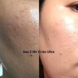 Vi kim tảo biển Utral V( lẻ theo cặp)