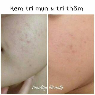 Kem Trị Thâm Handmade