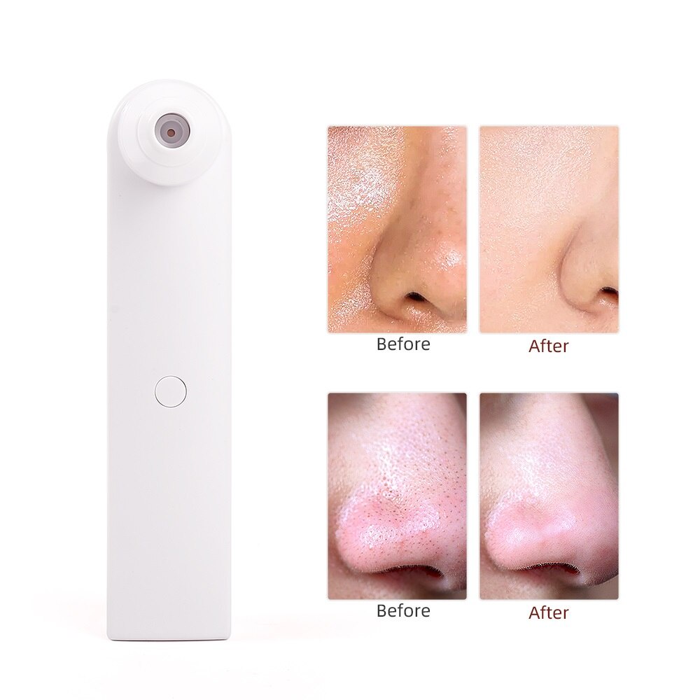 Máy hút mụn đầu đen FOREVERLILY làm sạch lỗ chân lông chăm sóc da mặt
