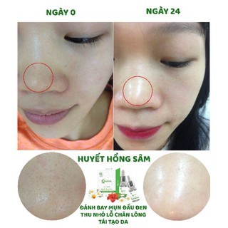 Serum Giảm Mụn Thâm Sẹo Rỗ Huyết Hồng Sâm 10ml Cam Kết Không Sưng Không Đỏ Hiệu Quả Ngay Lọ Đầu Tiên DASATA