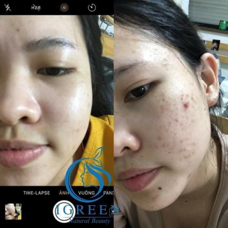 Serum SẠCH MỤN DIẾP CÁ IRGEEN_ GIẢM MỤN, GIẢM THÂM , SE KHÍT LỖ CHÂN LÔNG, SÁNG DA | BigBuy360 - bigbuy360.vn