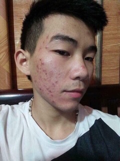 Mặt nạ mụn Huyền Phi(120k)