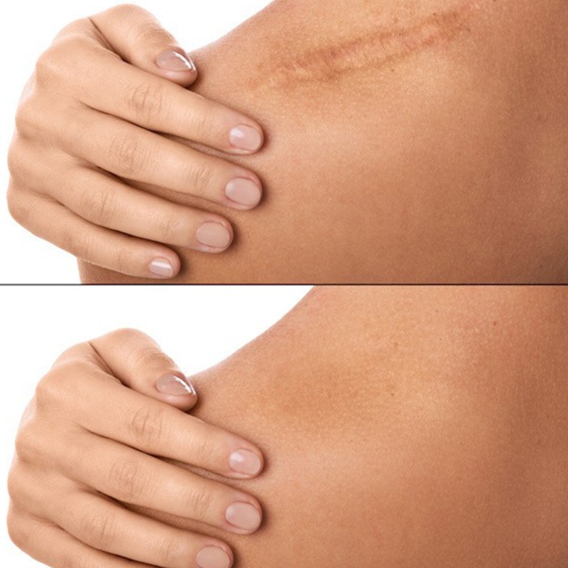 Youyo Tấm Silicone Hỗ trợ giảm sẹo Chống Thấm Nước An Toàn Không Độc Hại Cho Người Lớn Và Trẻ Em Ava