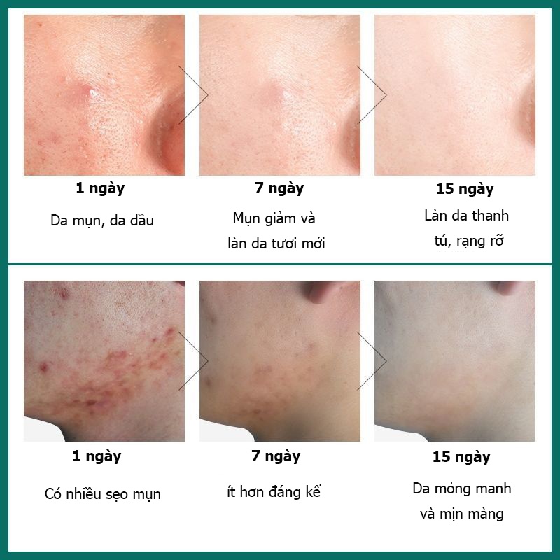 Sữa rửa mặt axit amin, Kiểm soát dầu và mụn Sữa rửa mặt[150ml], Làm sạch chuyên sâu, Soảng khoái nẩy da, Căn bằng nước và dầu, dưỡng ẩm làm trắng, thu nhỏ lỗ chân lông, kiểm soát dầu, mụn, da mẫn cảm cũng có thể sử dụng