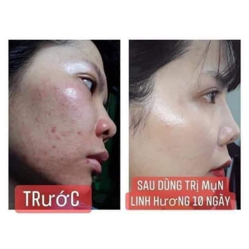 BỘ GIẢM MỤN, NGỪA MỤN, MỜ THÂM DA DẦU NHẠY CẢM[CHÍNH HÃNG] | BigBuy360 - bigbuy360.vn