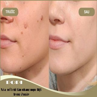 🌺Kem Xóa Nốt Ruồi