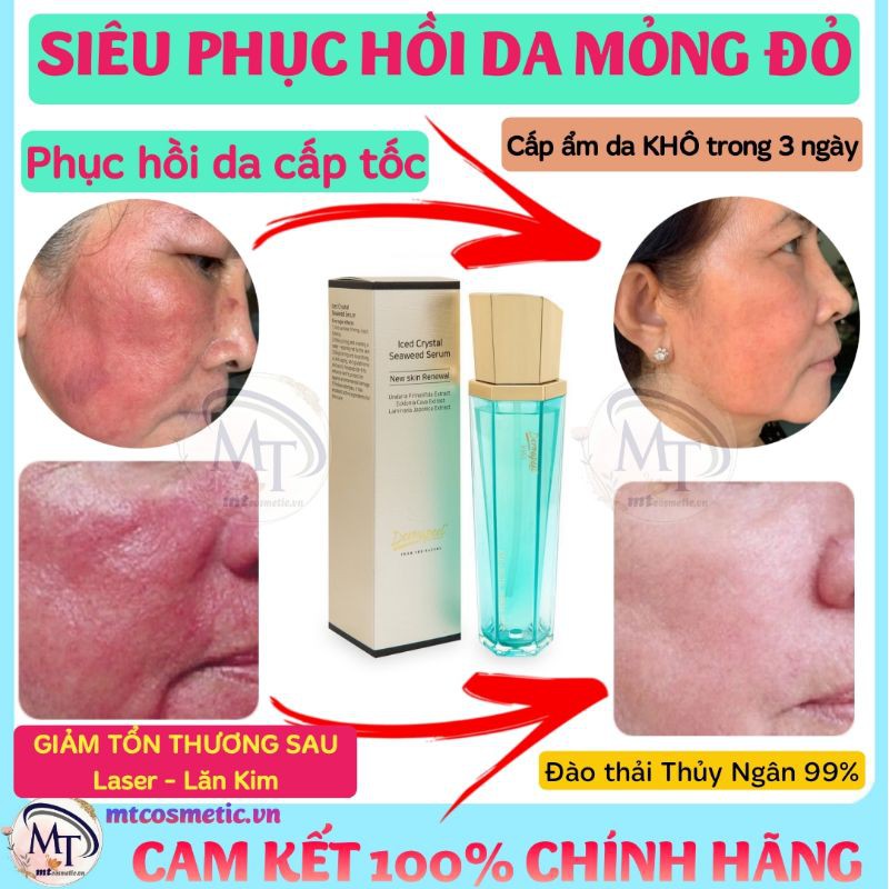 Combo Tảo Trứng Cá Tuyết - Tinh Tảo Băng - Phục Hồi Mô Da - Dày Thành Da - Xóa Tan Gân Máu Đỏ - Phục Hồi Da Mỏng Yếu