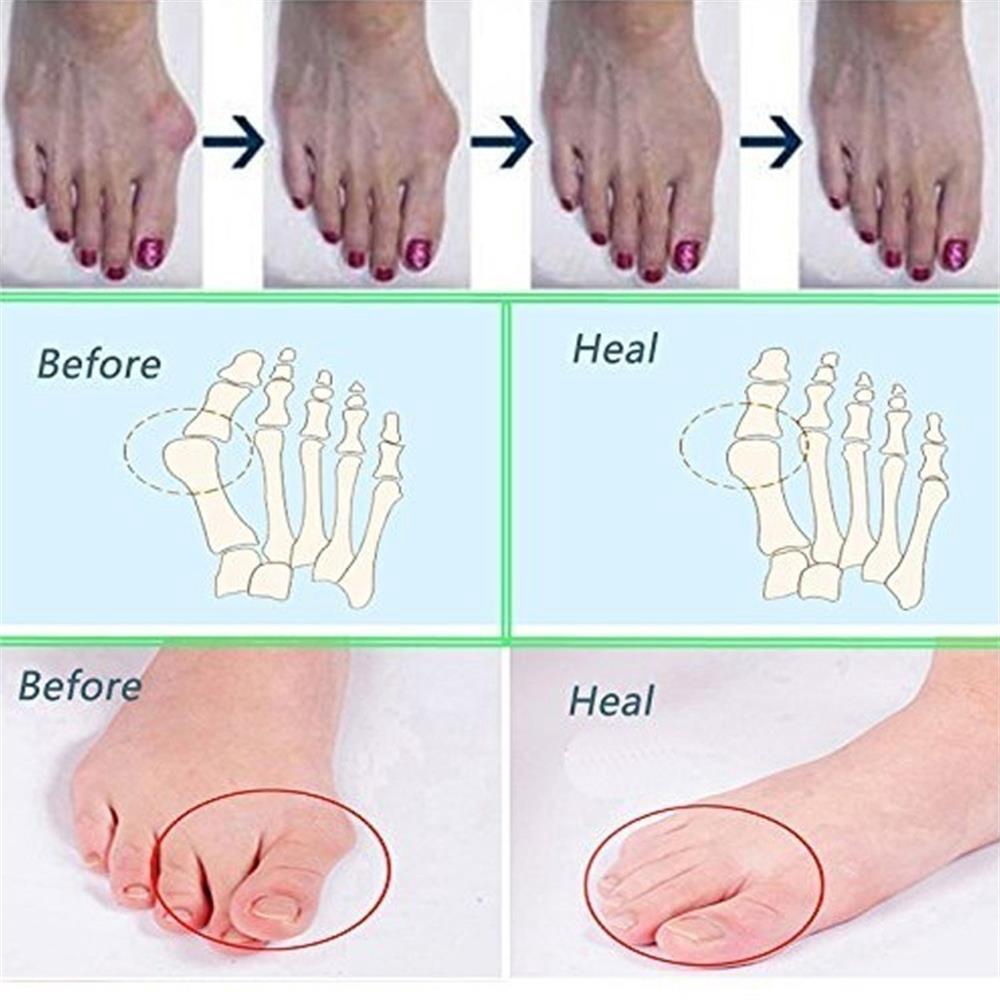 Dụng cụ tách ngón chân giảm đau chỉnh hình ngón chân cái tiện dụng