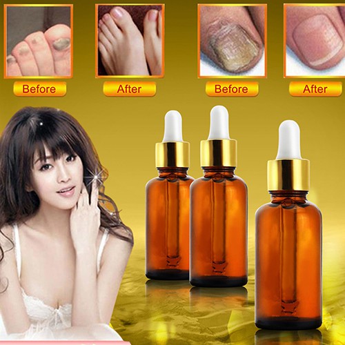 Gel Hỗ Trợ Cải Thiện Tình Trạng Nấm Móng Chân Móng Tay Hiệu Quả