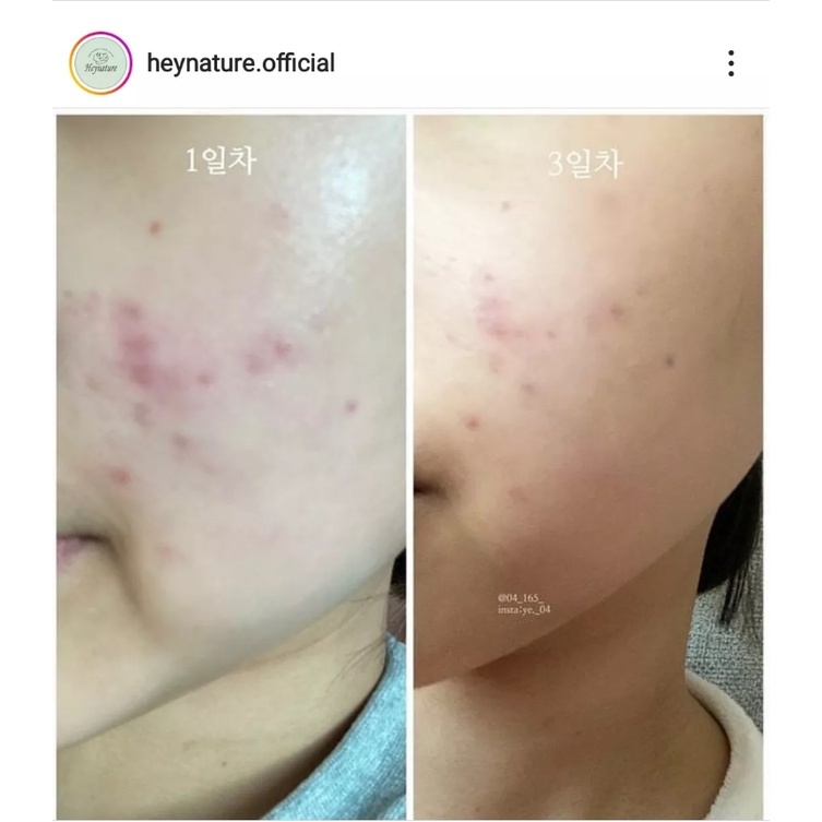 Toner diếp cá dịu da giảm mụn HEYNATURE ERSEONGCHO TONER SKIN CLAM