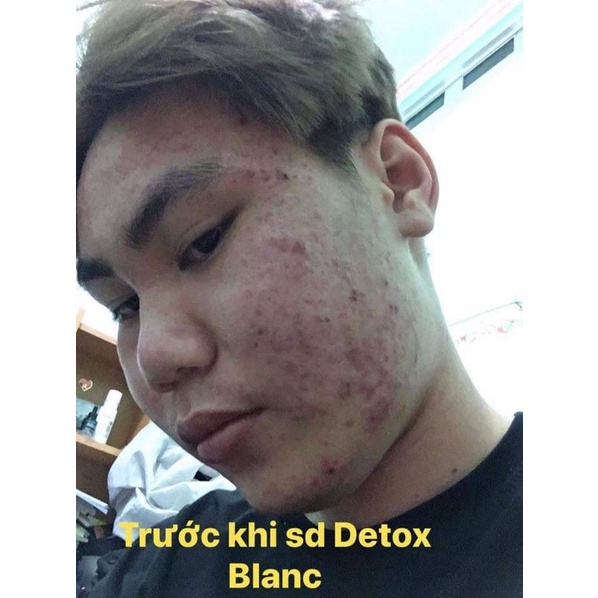 [CHÍNH HÃNG] Serum mụn Detox Blanc | BigBuy360 - bigbuy360.vn