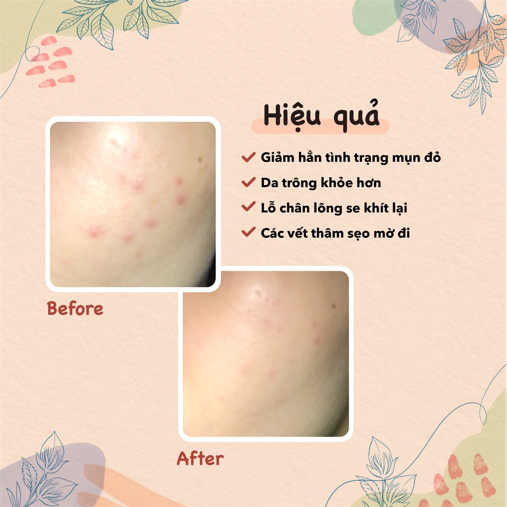 Tinh chất ngăn ngừa mụn và mờ thâm Themis Acne Repair Serum 30ml | BigBuy360 - bigbuy360.vn