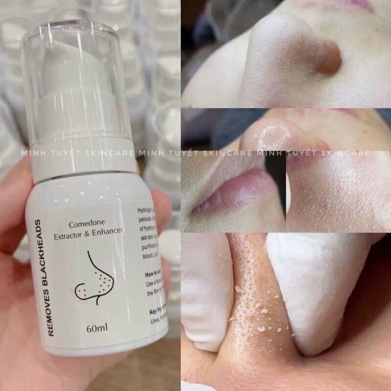 DUNG DỊCH Ủ MỤN ĐẦU ĐEN REMOVE BLACKHEAD | BigBuy360 - bigbuy360.vn