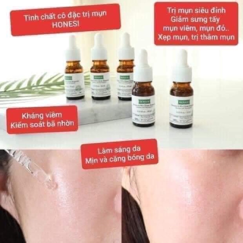 Honesi trị mụn chai lẻ 10ml