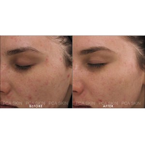 Kem Dưỡng ẩm sáng da cho da dầu mụn PCA Skin Clearskin mini