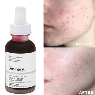 Serum peel da hoá học the ordinary peeling solution