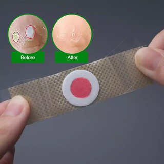 Miếng dán  mụn cóc, mụn nhọt C42