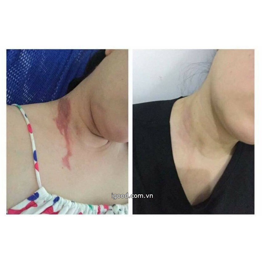 Kem trị sẹo Gentacin Nhật Bản 10g | BigBuy360 - bigbuy360.vn