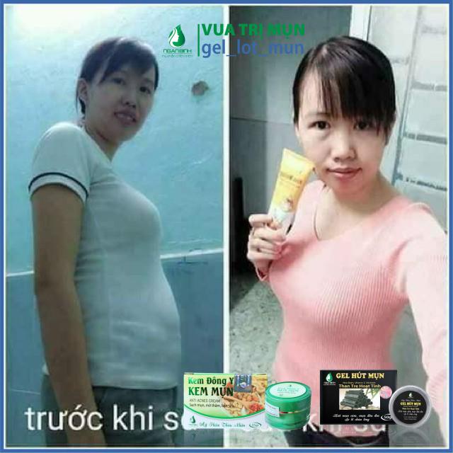  Kem Tan Mỡ Ngân Bình Gừng Ớt 150g . chính hãng mới hàng chuẩn công ty