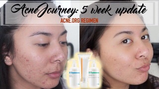 Tẩy da chết hoá học aha acne.org