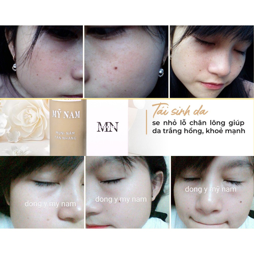 Combo Cải Thiện Mụn Siêu Tốc Mỹ Nam - Cải Thiên Tận Gốc Mụn, Thâm Nám, Tàn Nhang, Sẹo Rỗ
