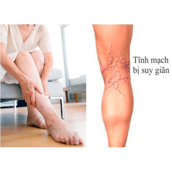 Gel Trị Giãn Tĩnh Mạch Varikosette Chính Hãng Nga