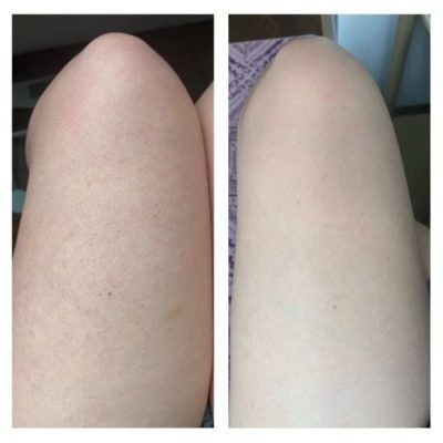 Kem dưỡng thể giảm viêm nang lông PLC 2% BHA | BigBuy360 - bigbuy360.vn